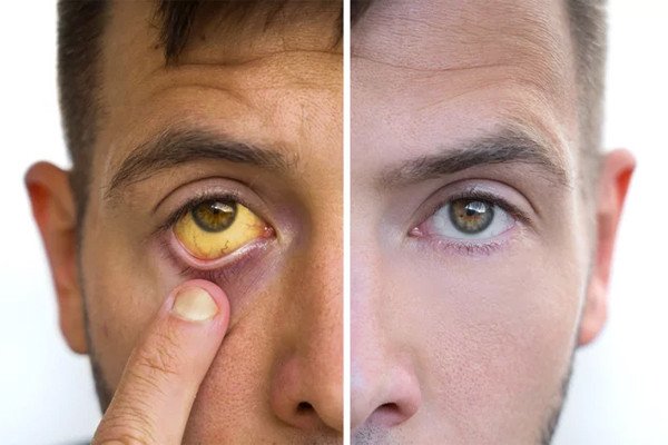 Những dấu hiệu nhận biết khi lá gan bạn đang quá tải
